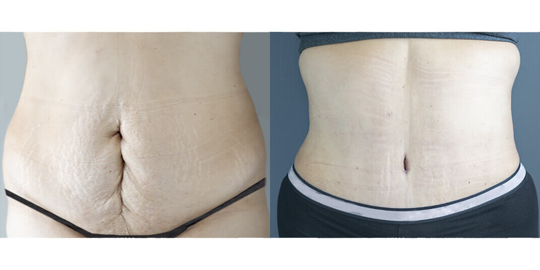 tummy tuck before and after houston