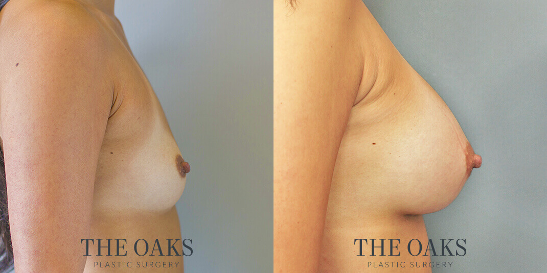 houston breast augmentation before & after 