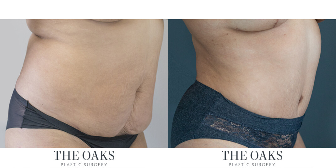 houston tummy tuck before & after
