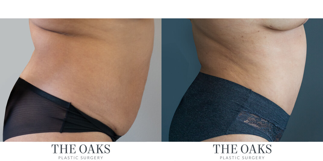 houston tummy tuck before & after