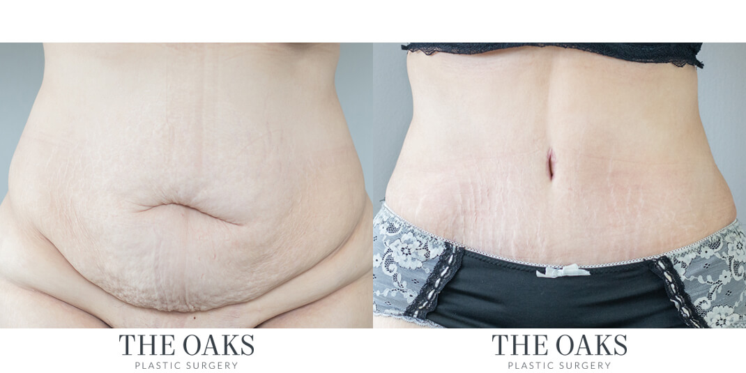houston tummy tuck before & after