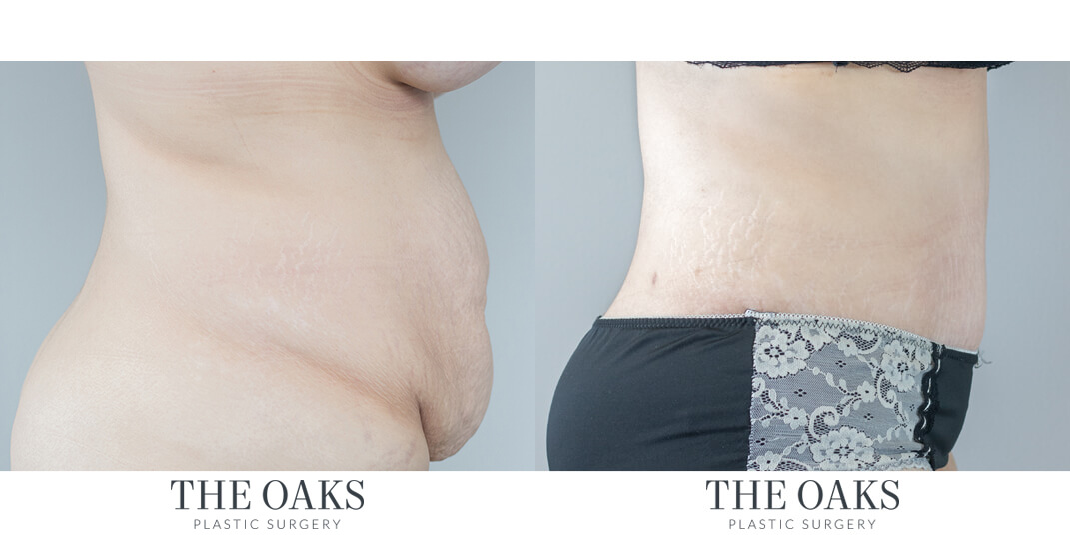 houston tummy tuck before & after