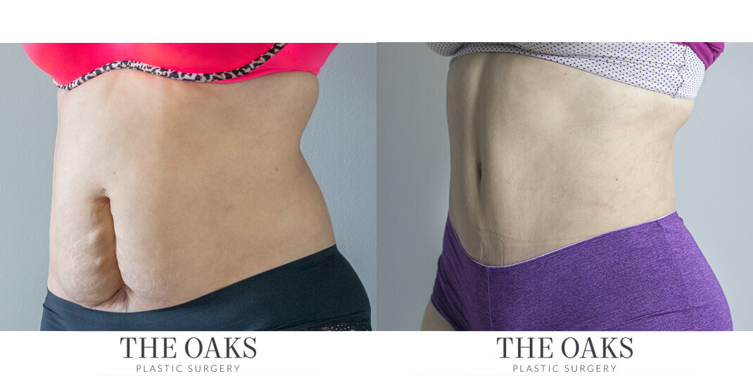 houston lipo before & after