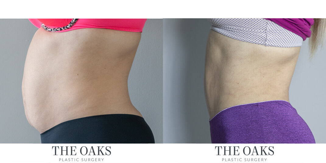 houston lipo before & after