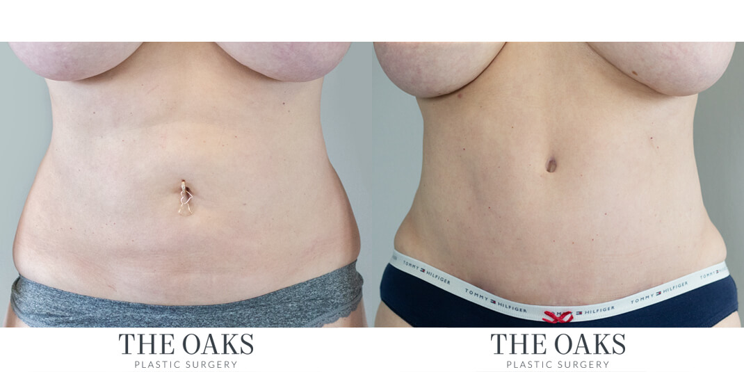 houston tummy tuck before & after
