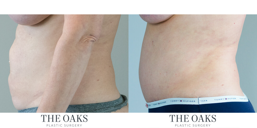 houston tummy tuck before & after