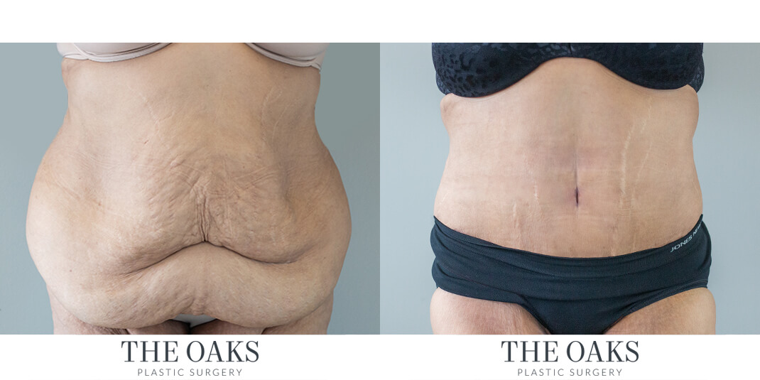 houston tummy tuck before & after