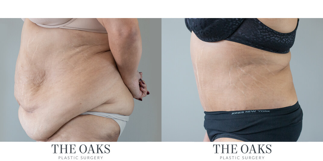 houston tummy tuck before & after