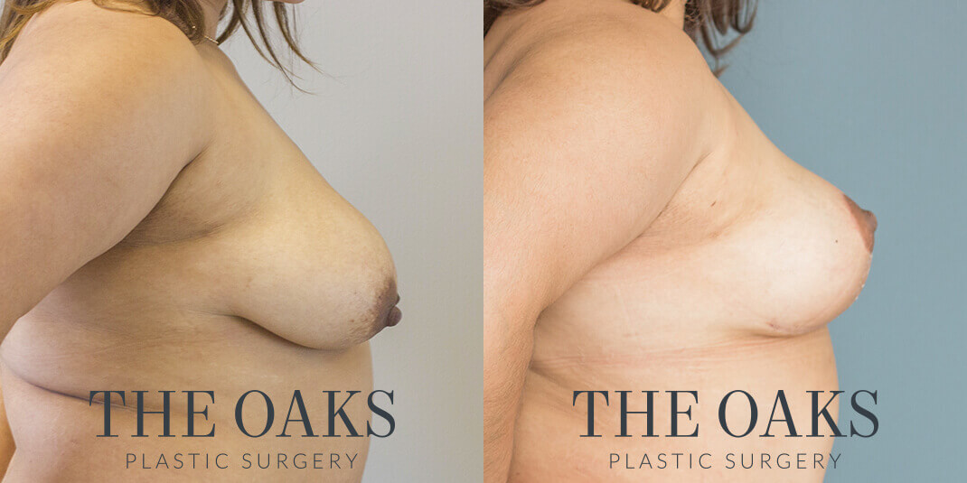 Breast Lift Houston Before & After | TOPS