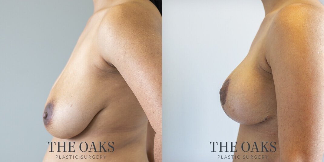 Breast Lift Houston Before & After | TOPS
