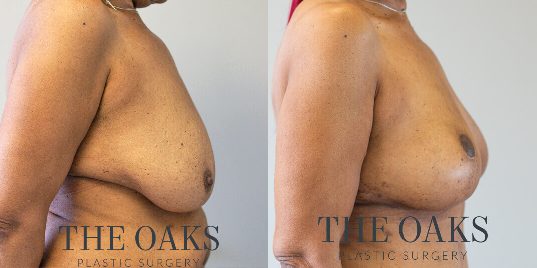 Breast Lift Houston Before & After | TOPS