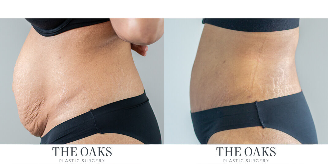 houston tummy tuck before & after
