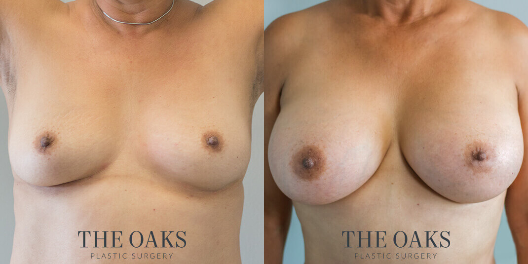 breast augmentation houston before & after