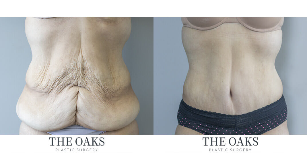 Houston Tummy Tuck Before & After | TOPS #1