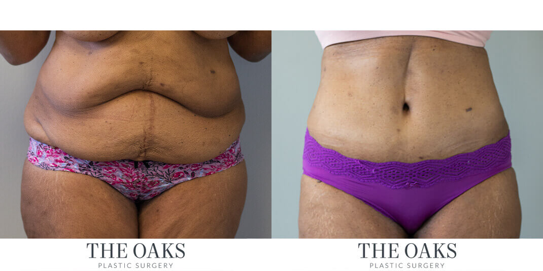 Houston Tummy Tuck Before & After | TOPS #6
