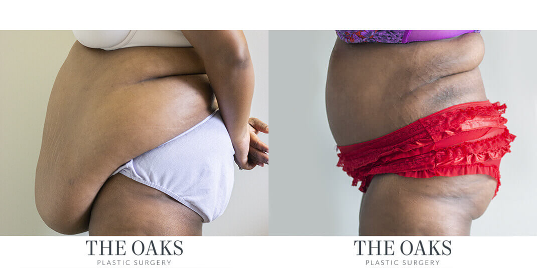 Tummy Tuck Houston Before & After | TOPS #1