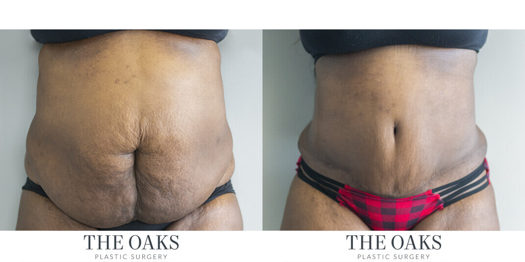 Tummy Tuck Houston Before & After | TOPS #1