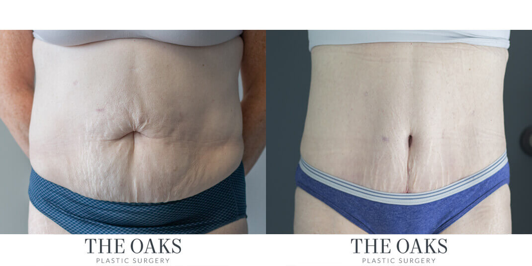 Houston Tummy Tuck Before & After | TOPS #1