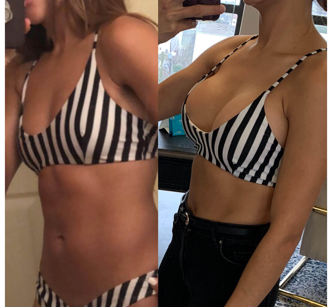 Breast Augmentation Houston After | Dr. Wijay