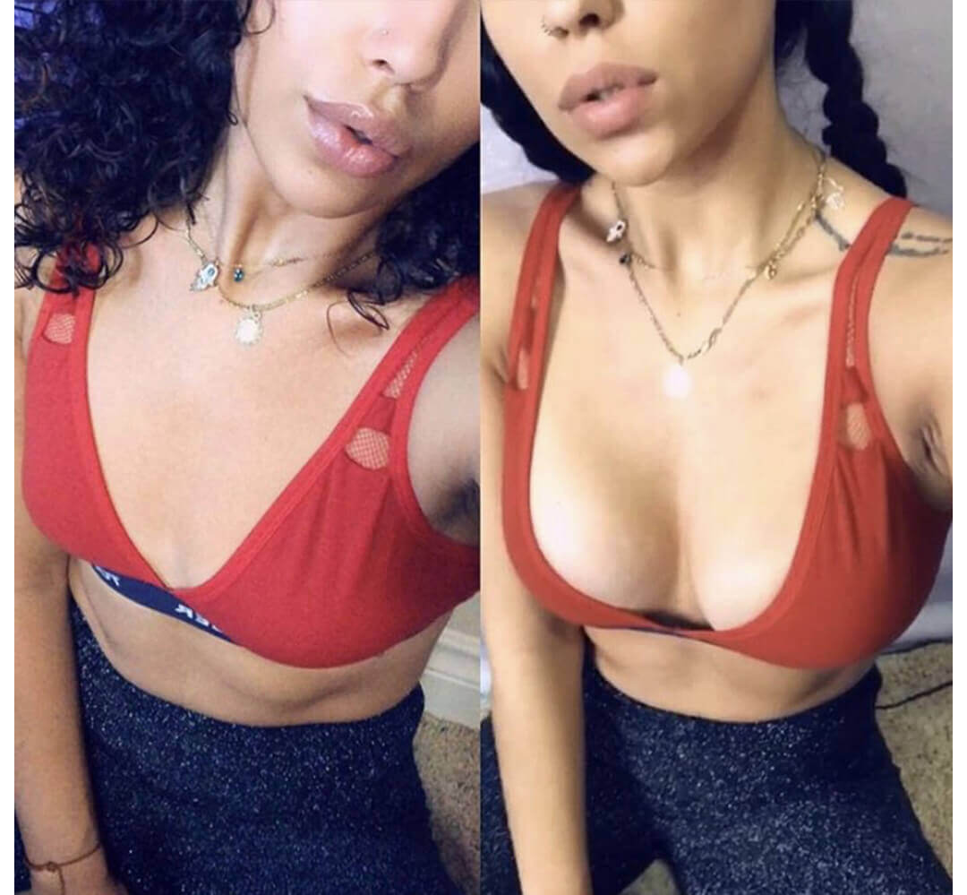 Brazilian Butt Lift Before & After | TOPS #1