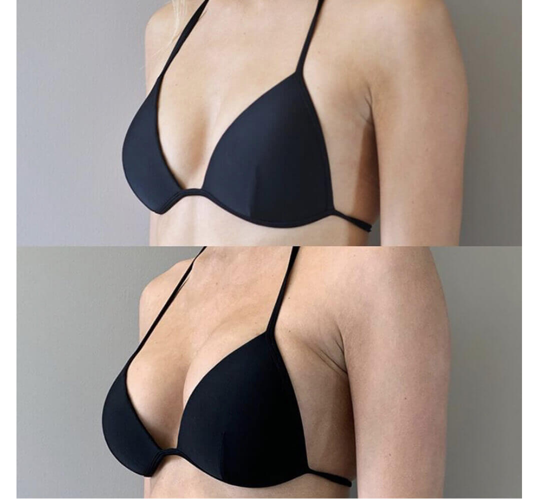 Breast Augmentation Houston After | Dr. Wijay