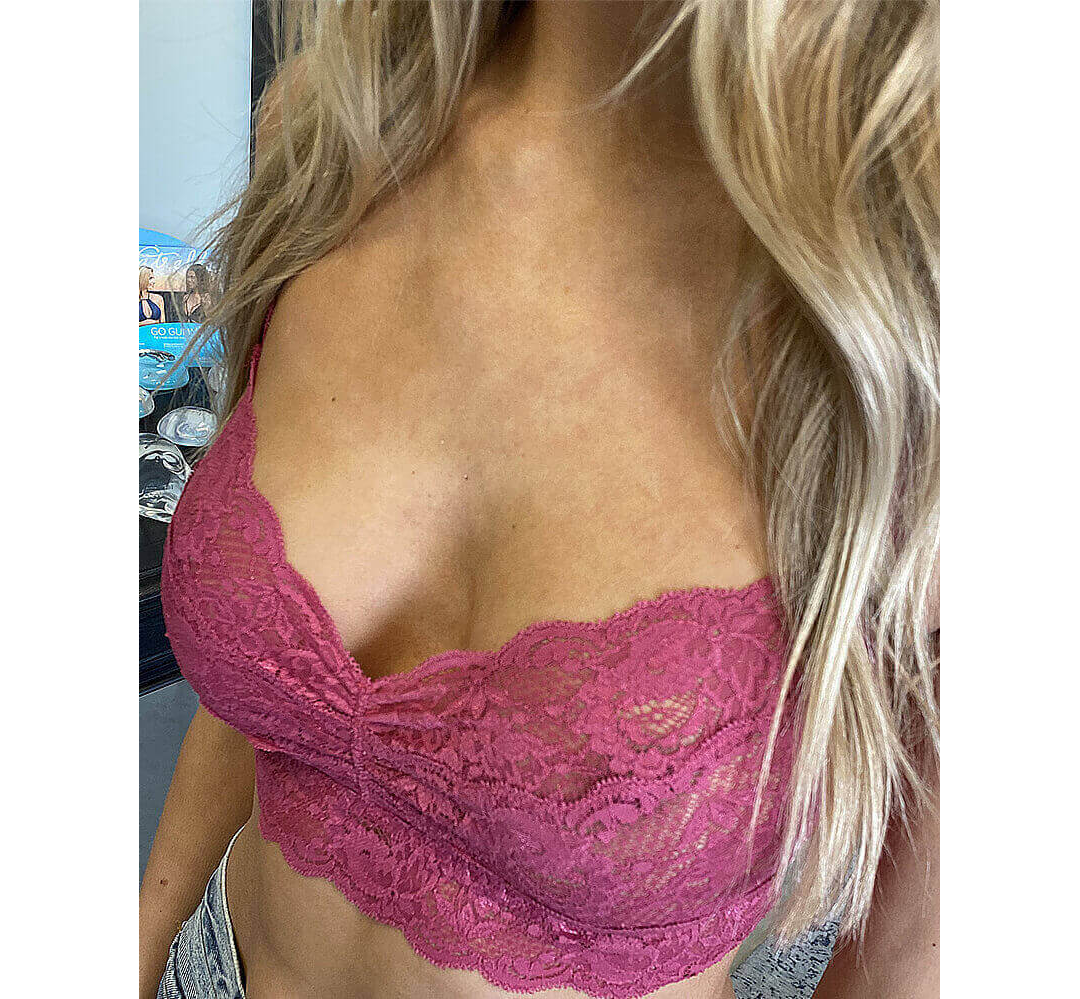 Breast Augmentation Houston After | Dr. Andry