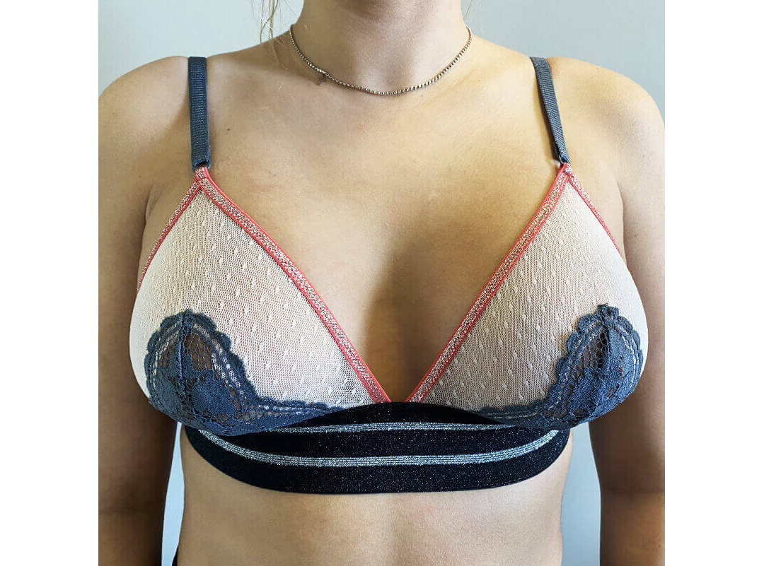 Breast Augmentation Houston After | Dr. Wijay