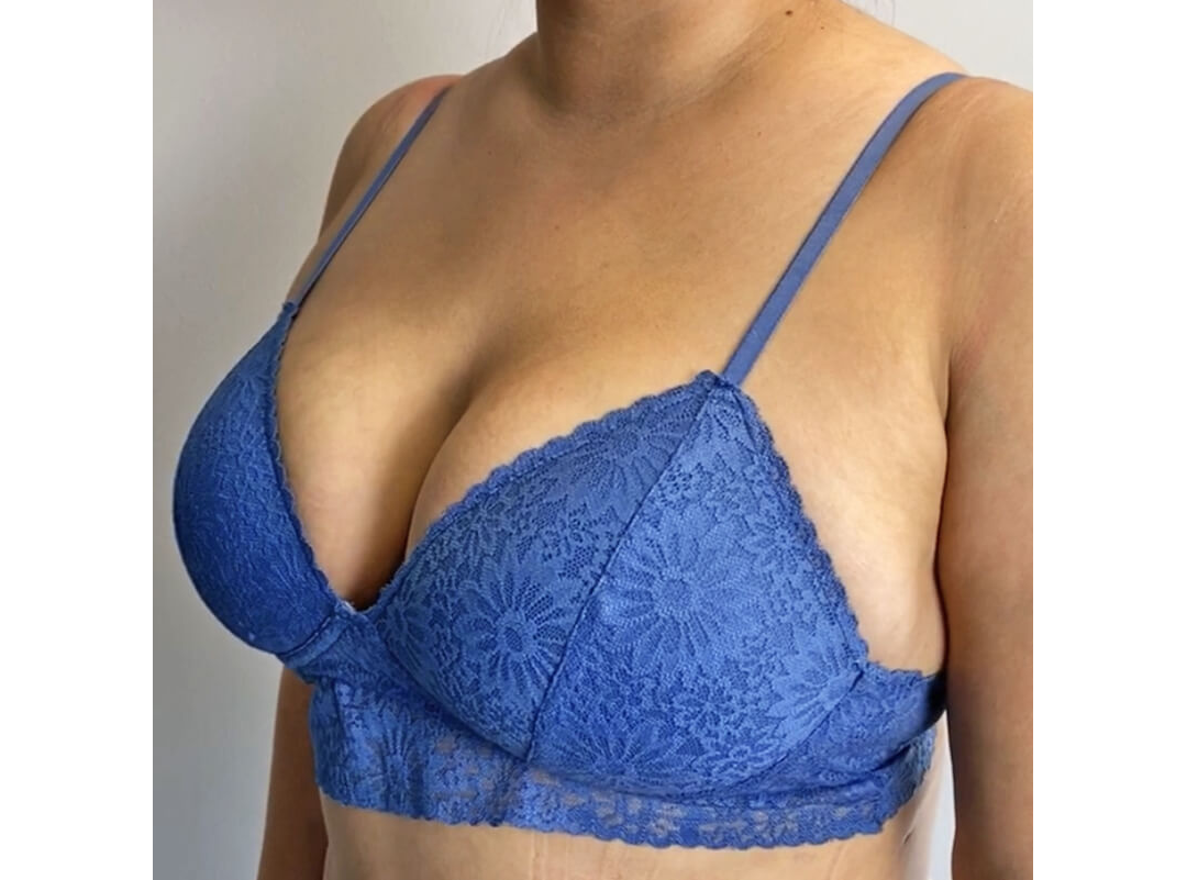 Breast Augmentation Houston After | Dr. Andry