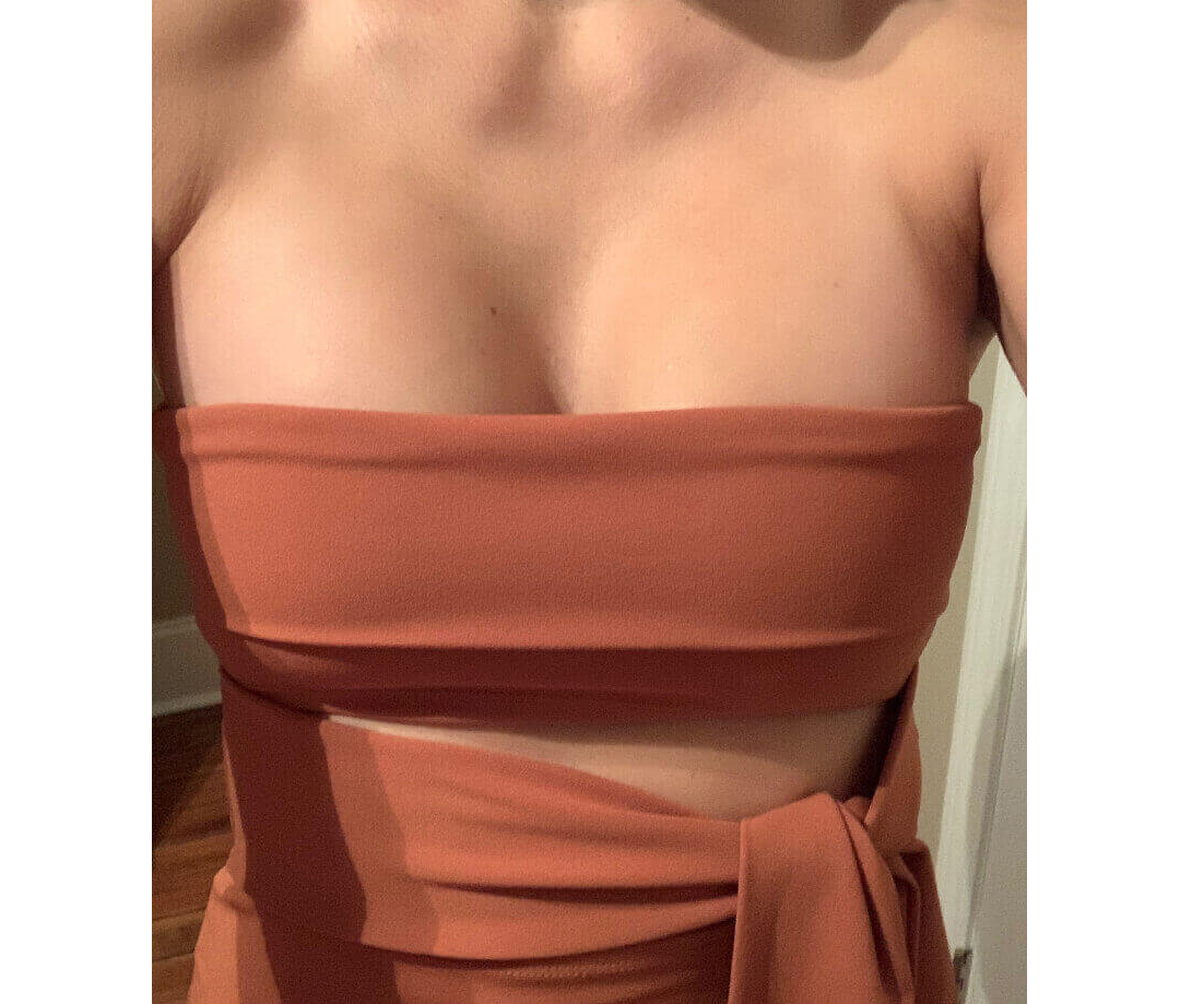 Breast Augmentation Houston