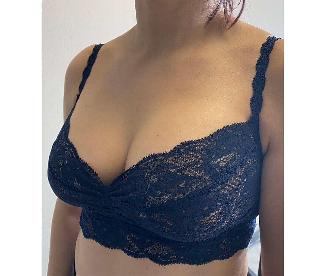 Breast Augmentation Houston After | Dr. Andry